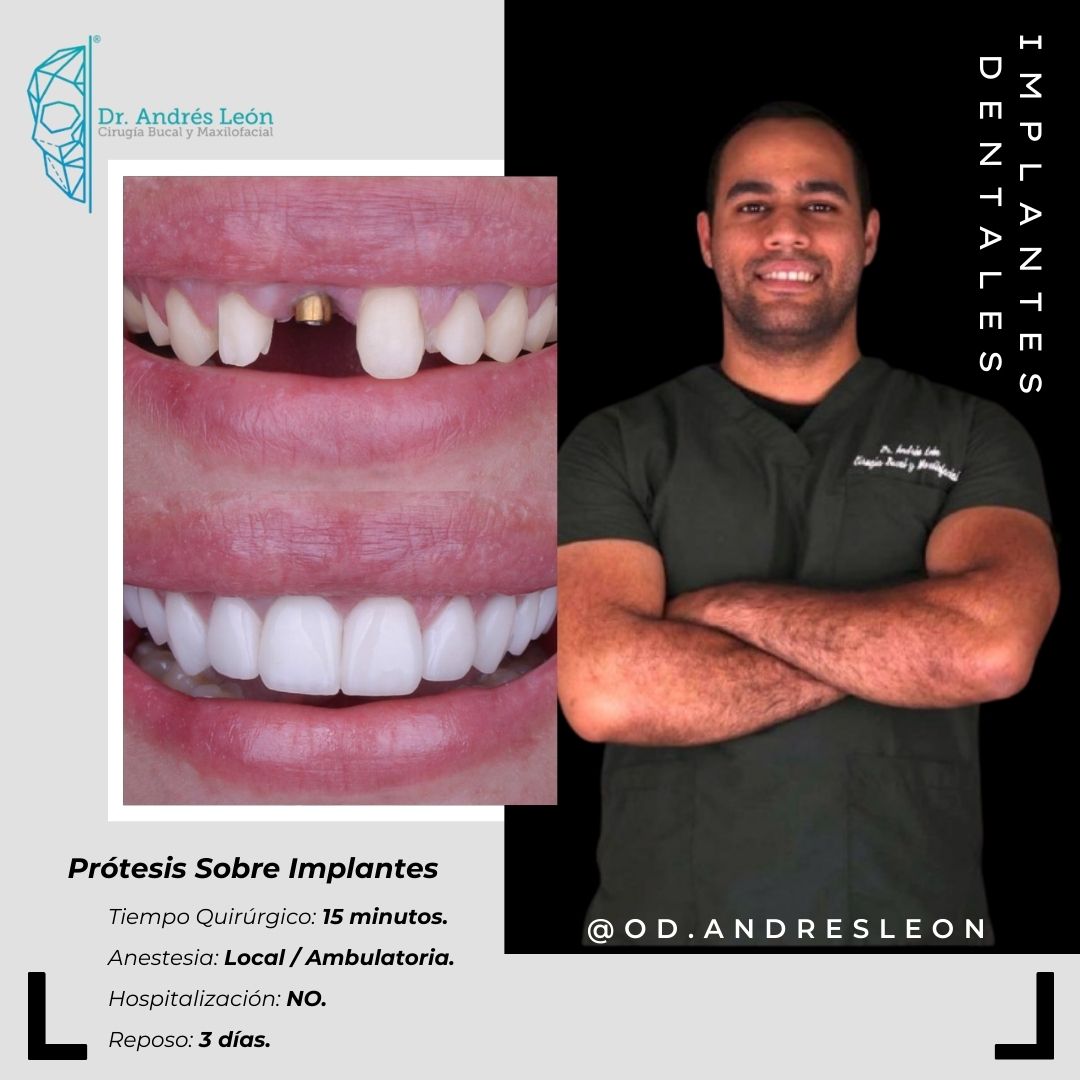 Implantes Dentales