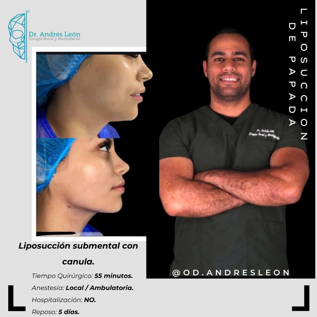 Liposuccion de Papada