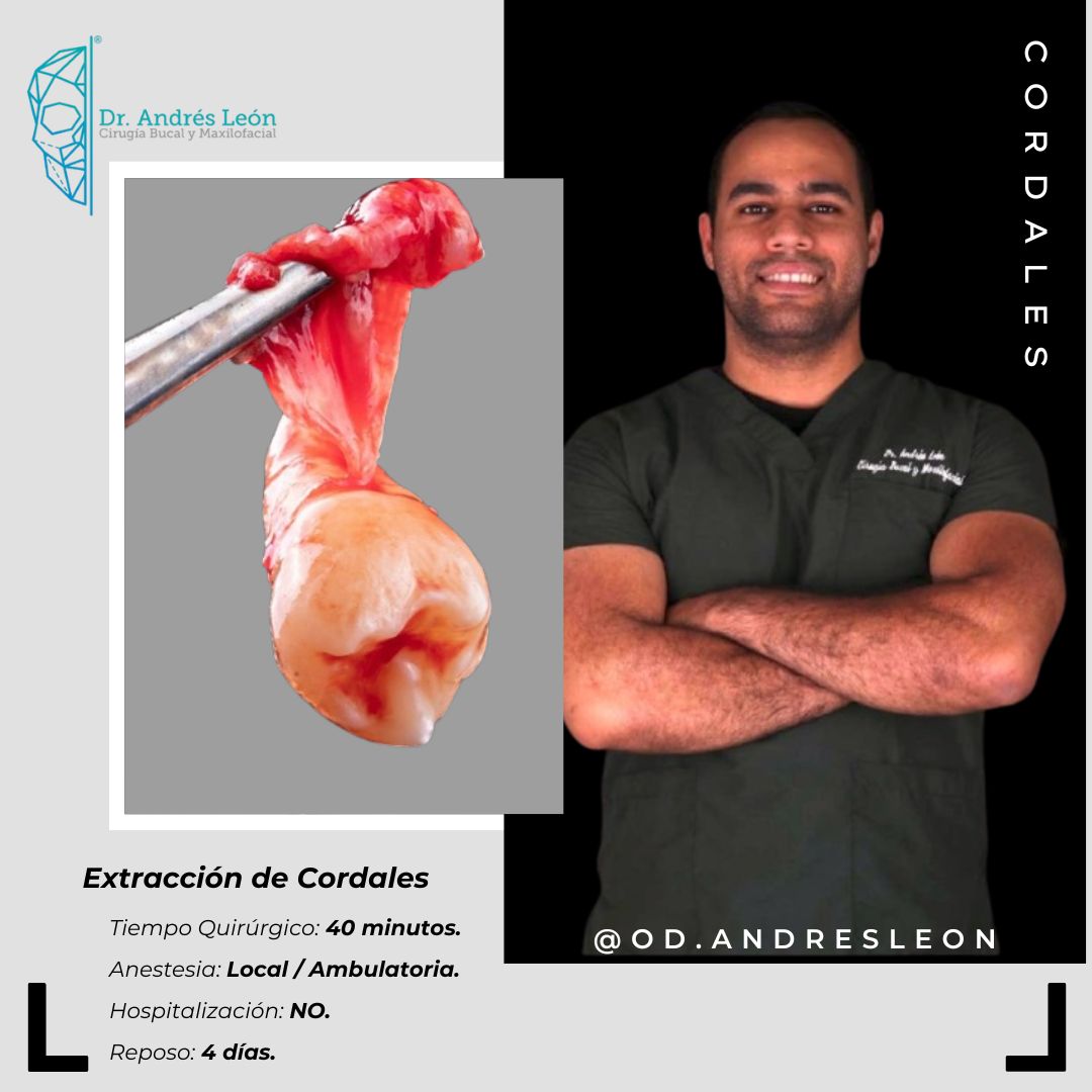 Extracción de Cordales