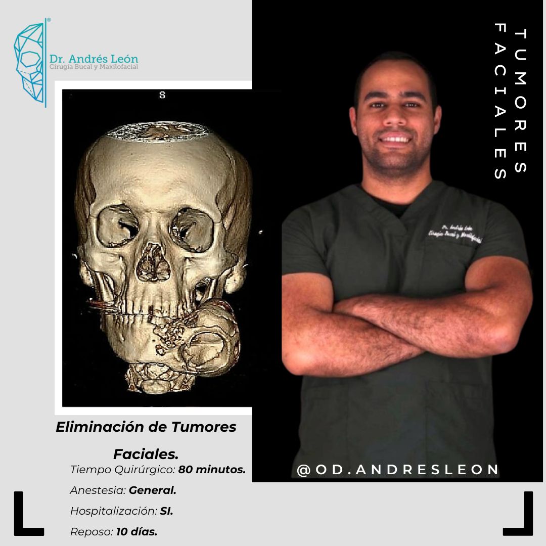 Tumores Faciales
