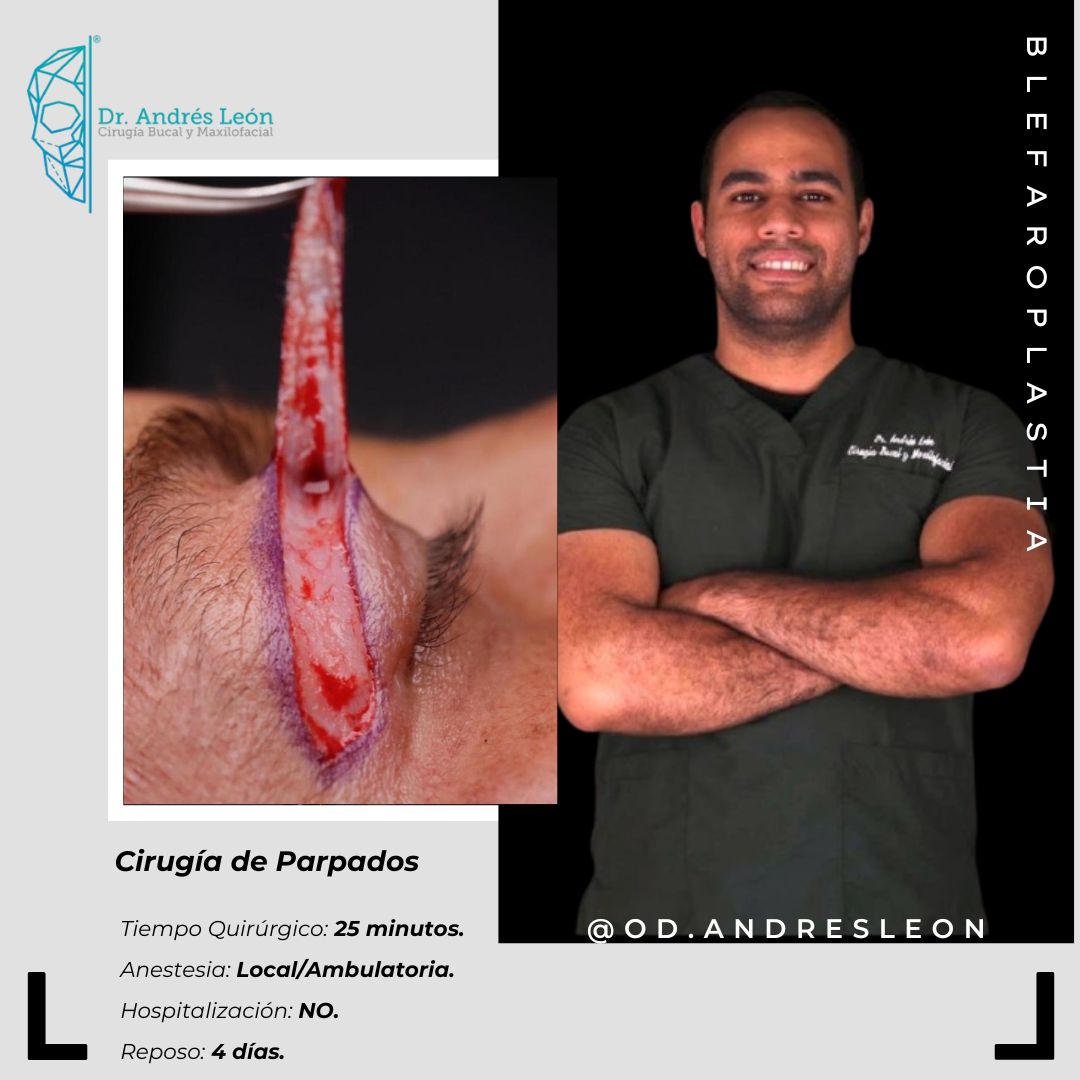 Blefaroplastia