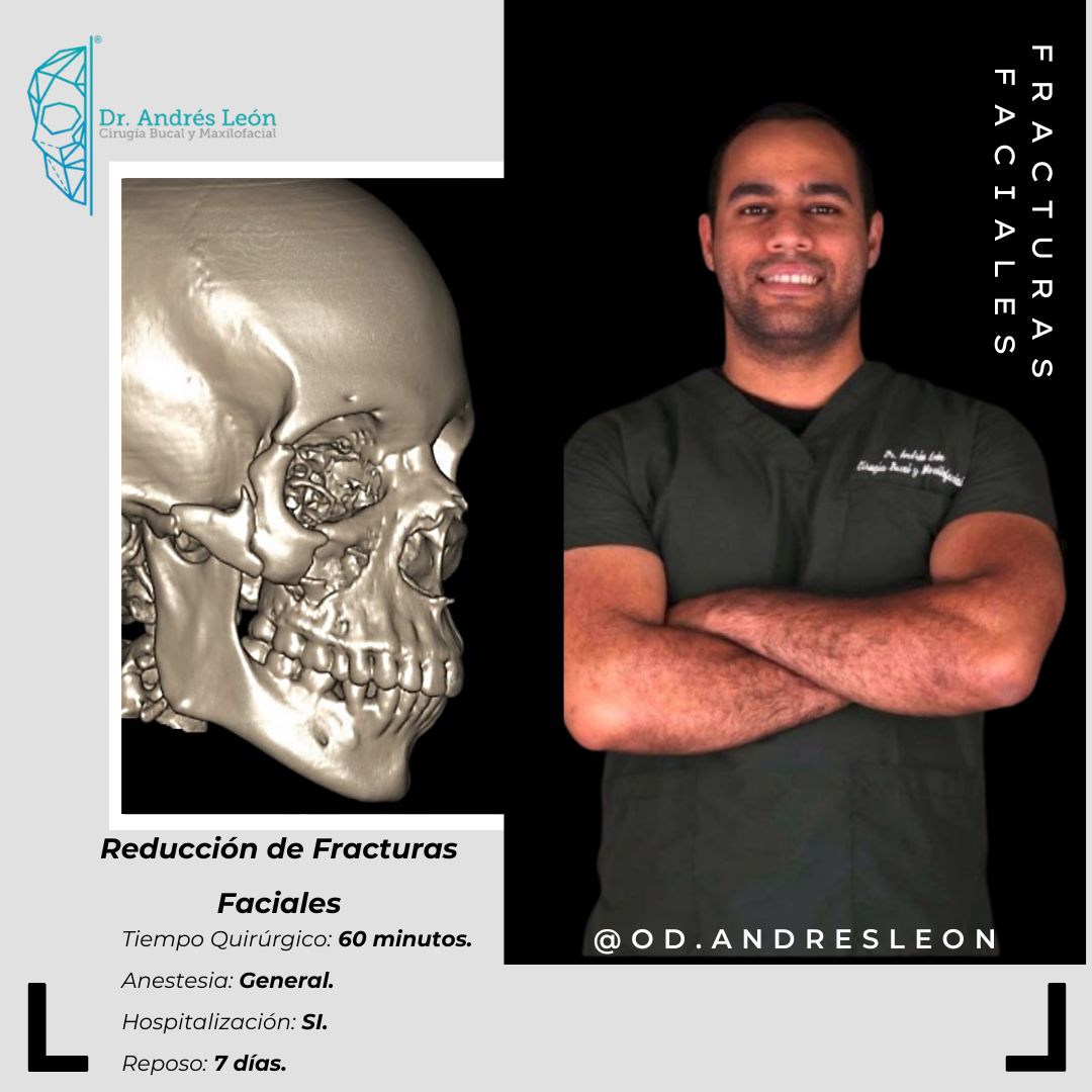 Fracturas Faciales