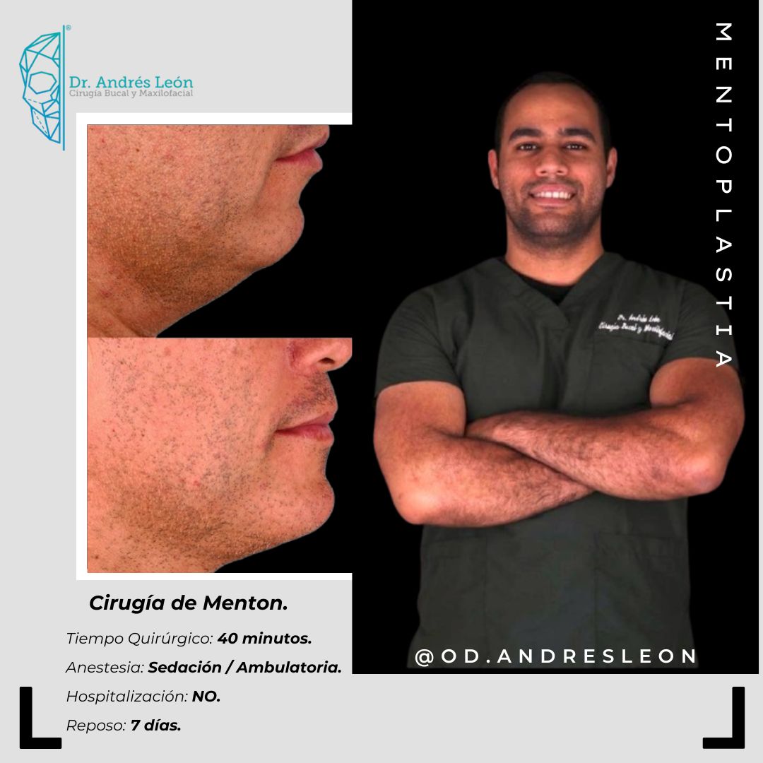 Mentoplastia